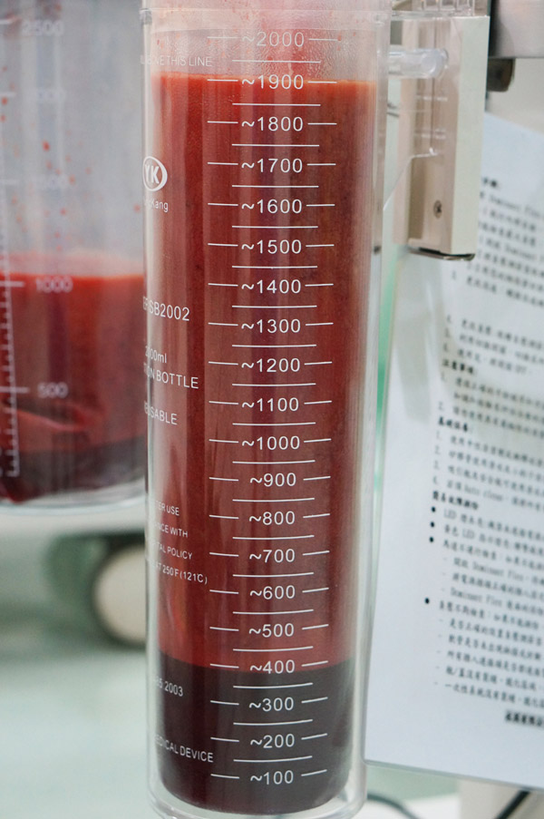 血水與脂肪無法分離影響填充體積,李岳樺醫師
